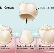 Image result for Dental Crown On Molar