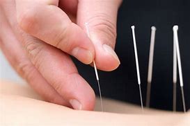 Image result for Japanese Acupuncture