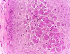 Image result for ZymaDerm Molluscum