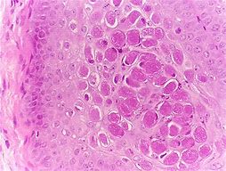 Image result for Molluscum Bodies Histology with Arrows