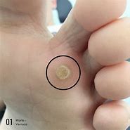 Image result for Corn Wart Treatment