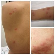 Image result for What Do Flea Bites Bed Bug Look Like