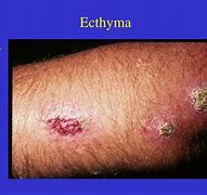 Image result for Ecthyma Contagiosum