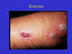 Image result for Acthyma
