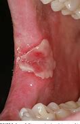 Image result for Syphilis