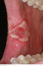 Image result for Syphilis On Gums