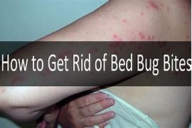 Image result for Bed Bug Bite Scars