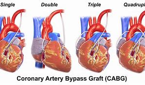 Image result for Woman Heart Bypass