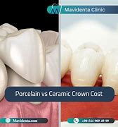 Image result for Difference Between Ceramic and Porcelain in Dentistry