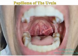 Image result for Growth On Uvula Papilloma