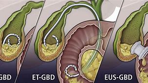 Image result for Gallbladder Drain Tube