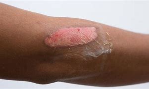 Image result for Burn Wound Stages