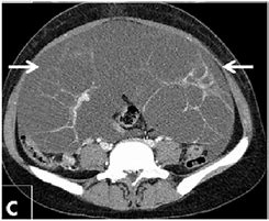 Image result for Multicystic Ovarian Mass