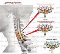 Image result for Cervical Spine C5 C6 Narrowing