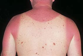 Image result for Acute SunBurn