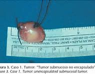 Image result for 2 Centimeter Tumor