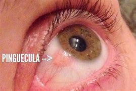 Image result for pinguecula image