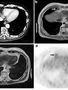 Image result for How Big Is 2 Cm Tumor