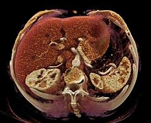 Image result for Tumor That Looks Like Grapes
