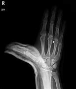 Image result for Sprained Thumb