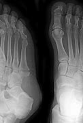 Image result for Jones Fracture Left Foot