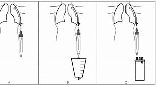 Image result for Chest Tube Pigtail Drain