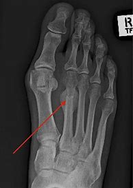 Image result for Displaced Metatarsal Fracture