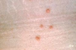 Image result for Molluscum Contagiosum Atopic Dermatitis
