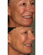 Image result for Tighten Loose Skin On Arms