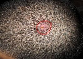 Image result for Cancerous Lumps On Head