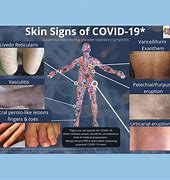 Image result for Covid 19 Skin Rashes