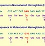 Image result for Heterozygous Sickle Cell