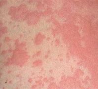 Image result for Fish-Oil Allergy Rash