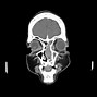 Image result for Inverted Papilloma of Sinus