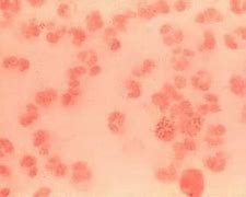 Image result for Gonorrhea Pustules