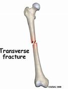 Image result for Transverse Bone Fracture