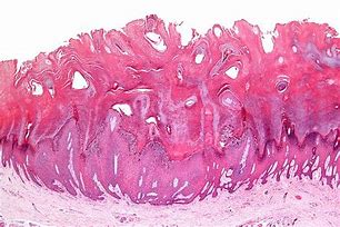 Image result for Genital Wart Long-Lasting