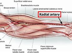 Image result for Radial Artery Catheterization