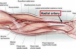 Image result for Radial Artery Aneurysm