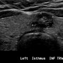 Image result for Spongiform Thyroid Nodule Ultrasound Images