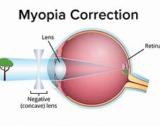 Image result for Myopia Lens Concave or Convex