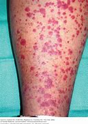 Image result for Lupus Vasculitis