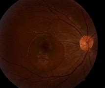 Image result for Central Serous Retinopathy Oct