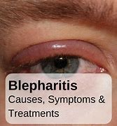 Image result for Blepharitis
