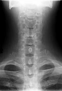 Image result for X-ray Cleft Palate
