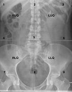 Image result for Abdomen X-Ray