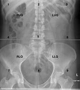 Image result for Abdominal Lateral