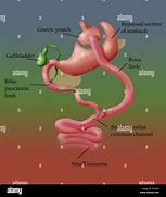 Image result for Roux En Y Gastric Bypass