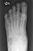 Image result for Oblique Fracture 5th Metatarsal