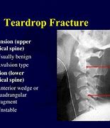 Image result for Teardrop Fracture Lumbar Spine
